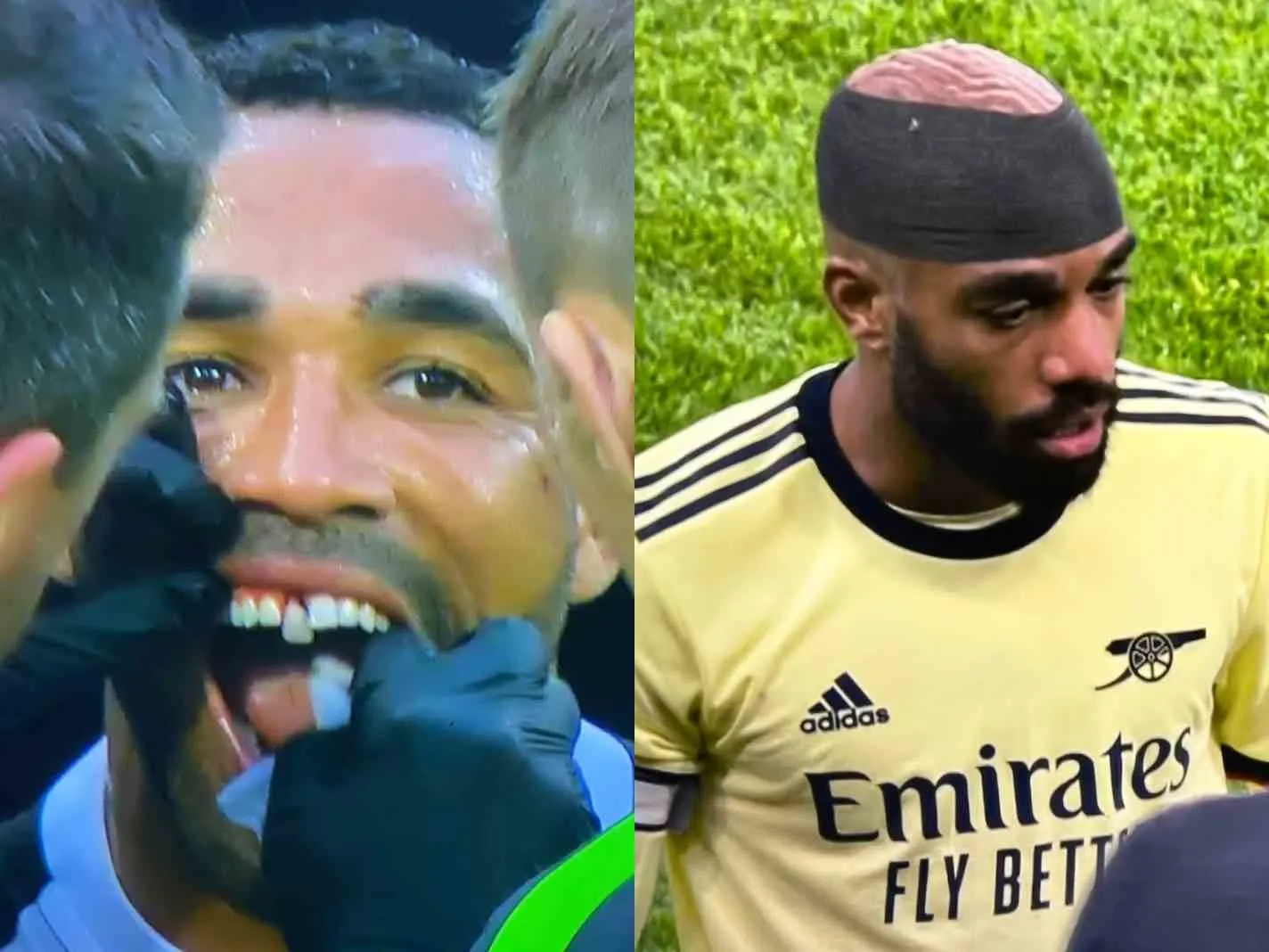 In this image - Callum Wilson has tooth hanging out as Alexandre Lacazette appears to reveal his brain