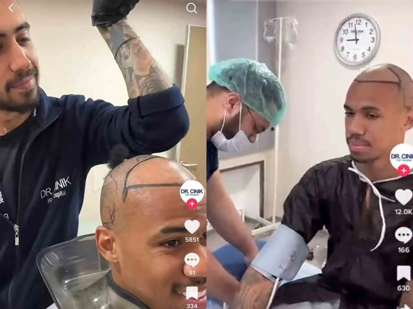 Gabriel Magalhaes during his hair transplant procedure