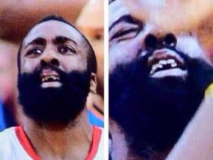 How Much Did James Harden Spend On Getting His Teeth Fixed