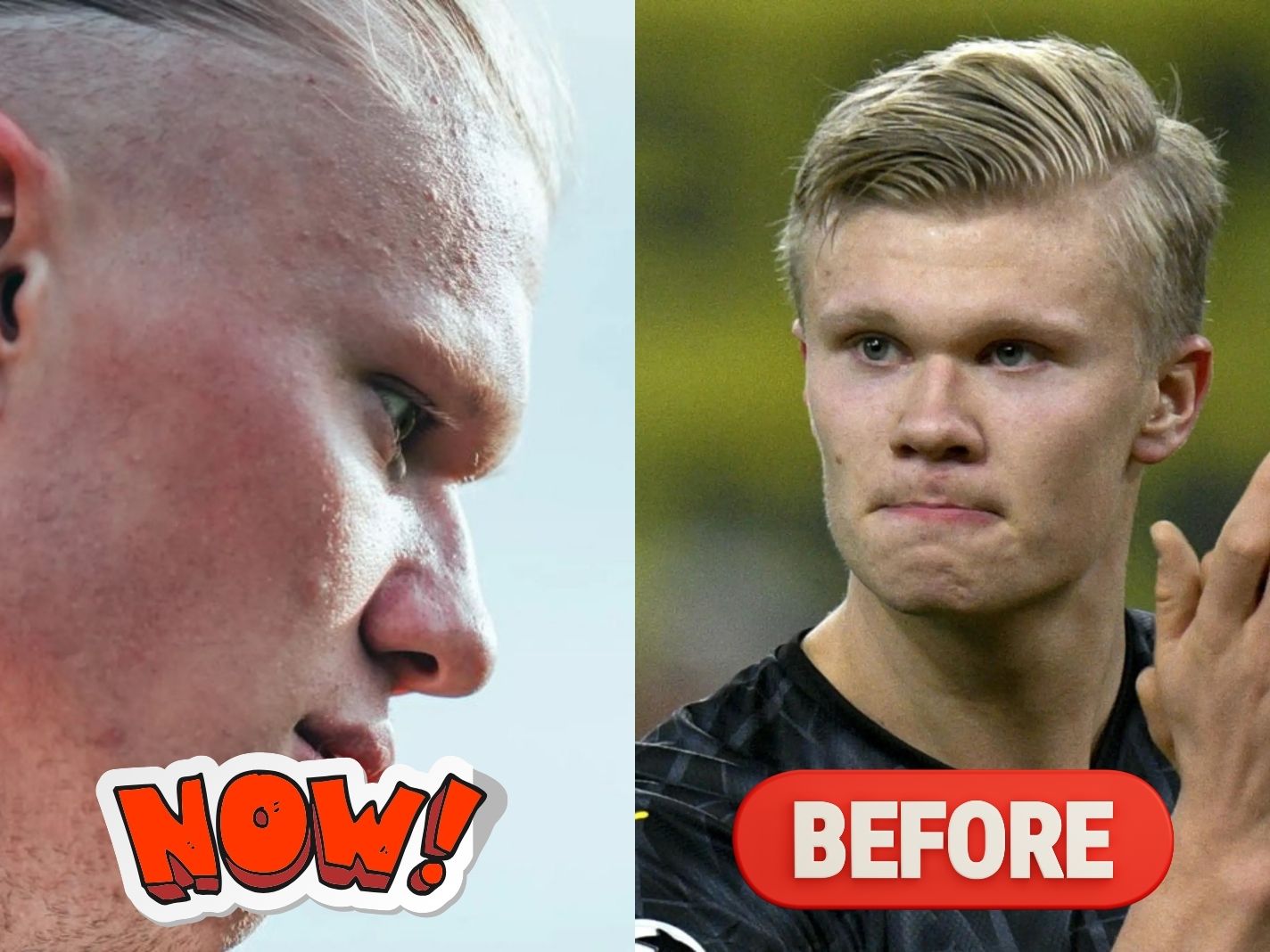 Real Reason Fans Think Erling Haaland is Ruining His Hairline